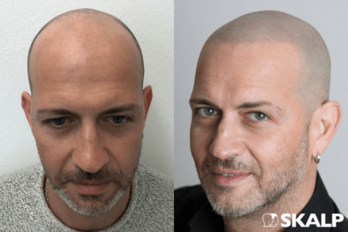 Cómo combatir las entradas